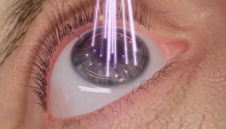 cirurgia ocular a laser