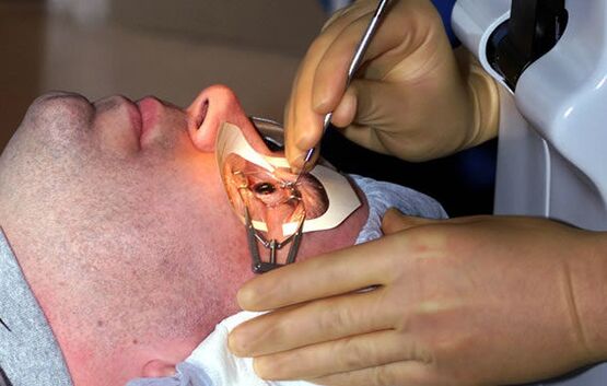 Escleroplastia para miopia para estabilizar a visão