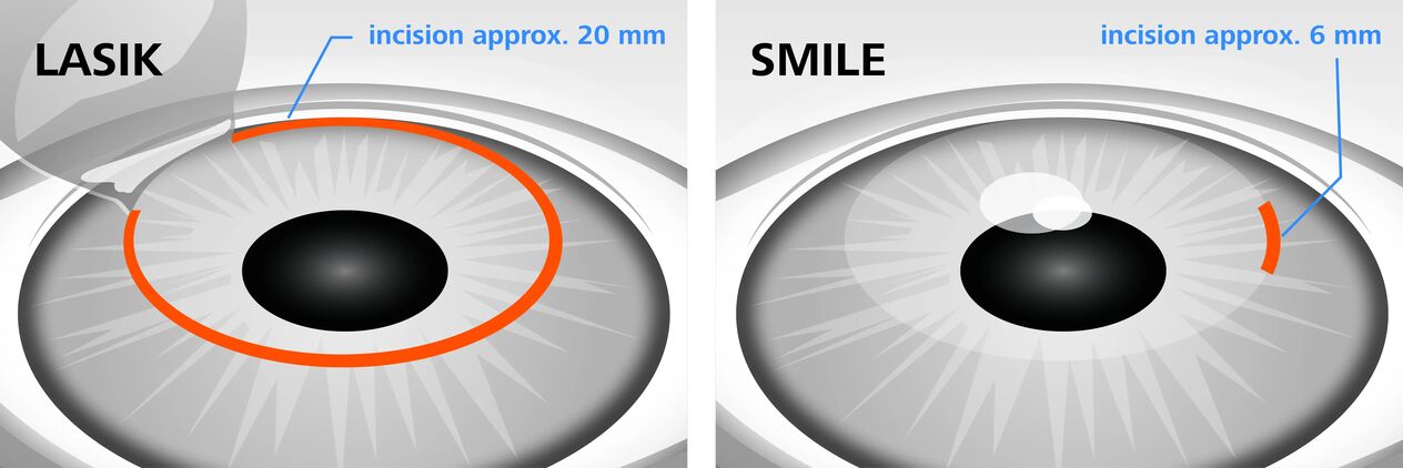 Comparação dos métodos de correção da visão a laser LASIK e SMILE